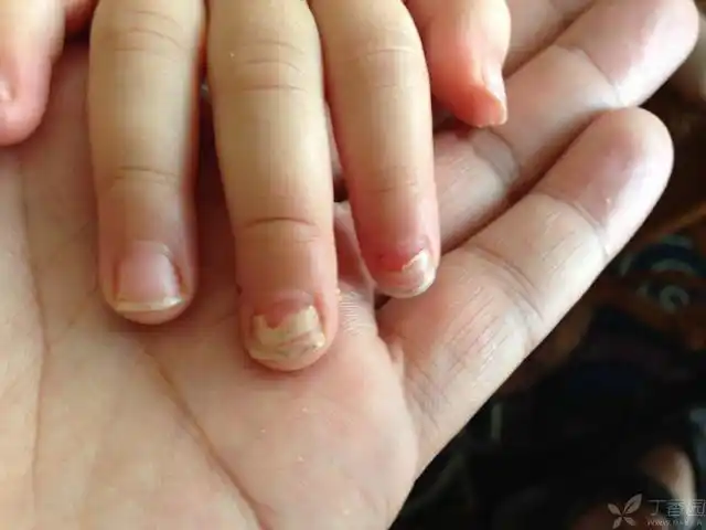 【求助】小儿指甲脱落是灰指甲吗