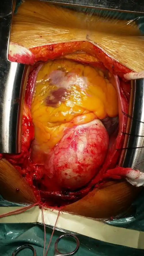 鸡蛋壳样升主动脉瘤