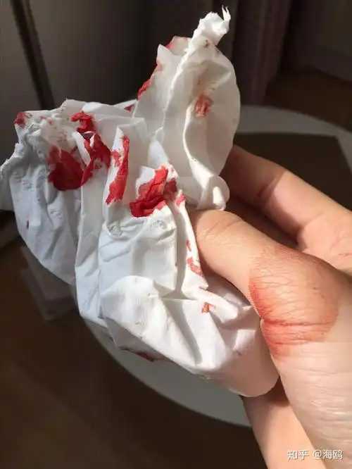 18,16年下半年开始流鼻血17,便秘,我是习惯性便秘,且有痔疮,比较严重