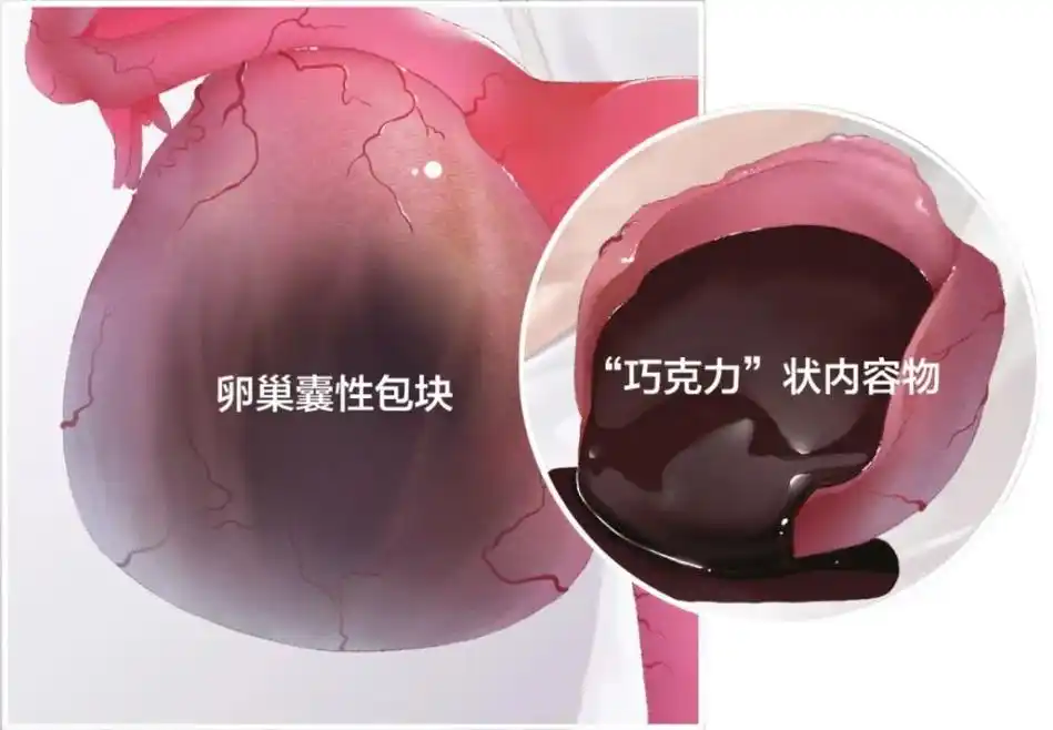 便宜!盆腔囊肿是什么"比比皆是"-第1张图片-金昌博客