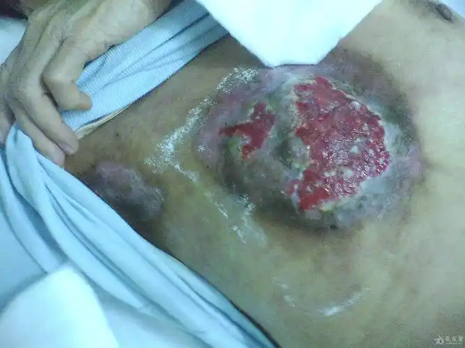 乳腺癌 出现这情况 请教下各位有没好的办法