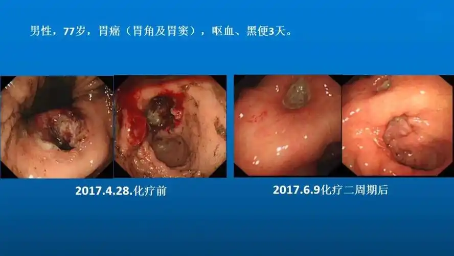 教学ppt消化道晚期恶性肿瘤出血的内镜治疗