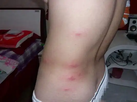 虫咬性皮炎图片 (109)_有来医生