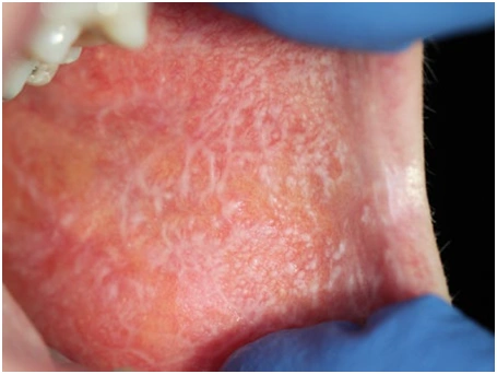 怀疑口腔扁平苔藓什么情况下需要做活检?