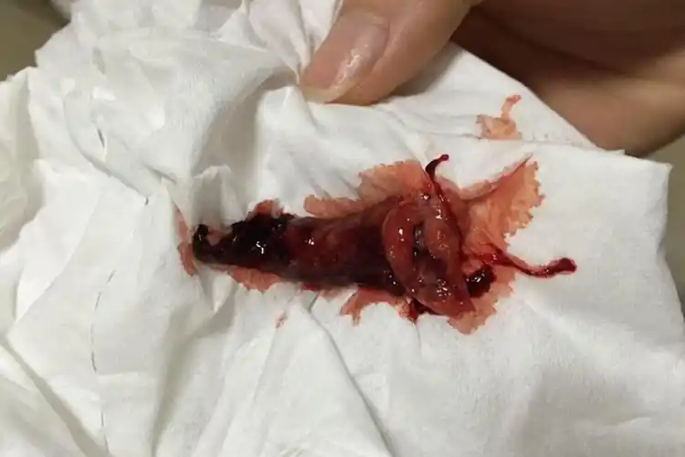 月经里排出息肉图片_有来医生