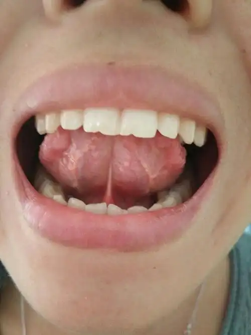 舌头上下都长疙瘩,是什么情况,舌苔下面的疙瘩细长粉红色的