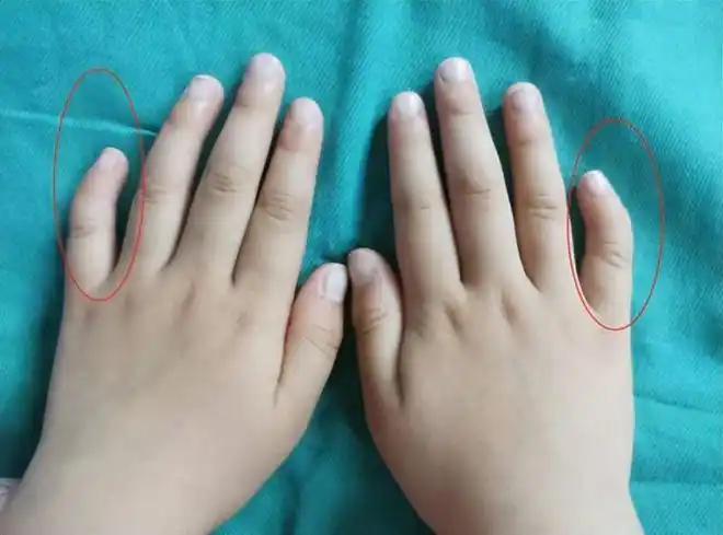 畸形程度会越来越重,而且女孩子长大后会因手指畸形而产生自卑心理