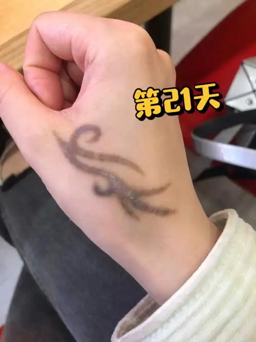 皮秒洗纹身恢复第21天