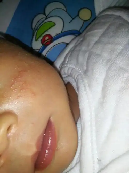 宝宝脸上长了像粉刺一样的小粒粒是什么东西啊!