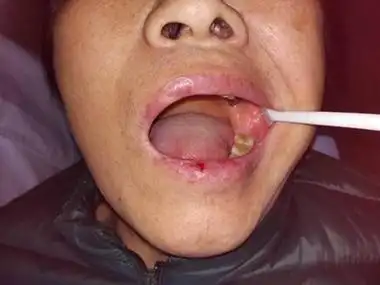 扁平苔藓口腔内侧黏膜有白色糜烂图-有来医生