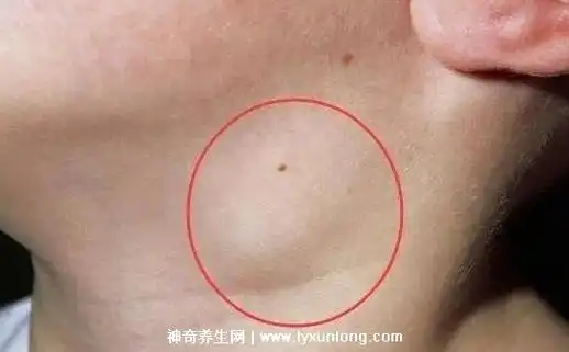 颈部淋巴结肿大图片症状,侧面位置会有肿物伴随疼痛感(要重视)