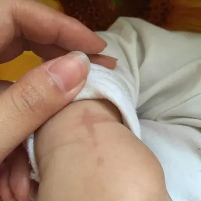 七个月宝宝身上突然长出这样的斑,谁知道怎麼回事?