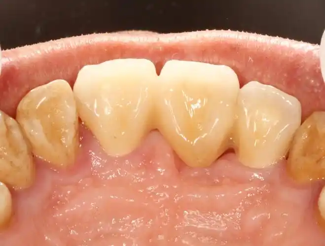 lava氧化锆全瓷桥-杜莉专用 - 好大夫在线