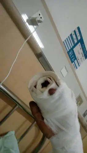 手指断了怎么赔偿