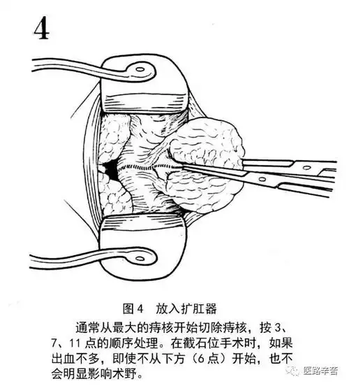痔手术图解 | 混合痔外剥内扎术