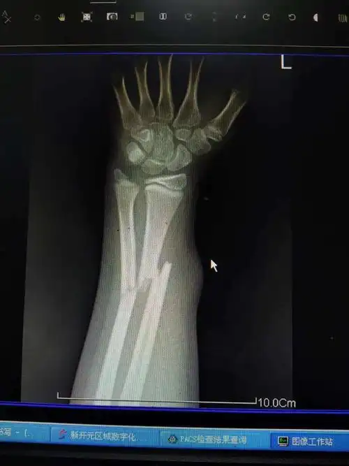 左尺桡骨双骨折