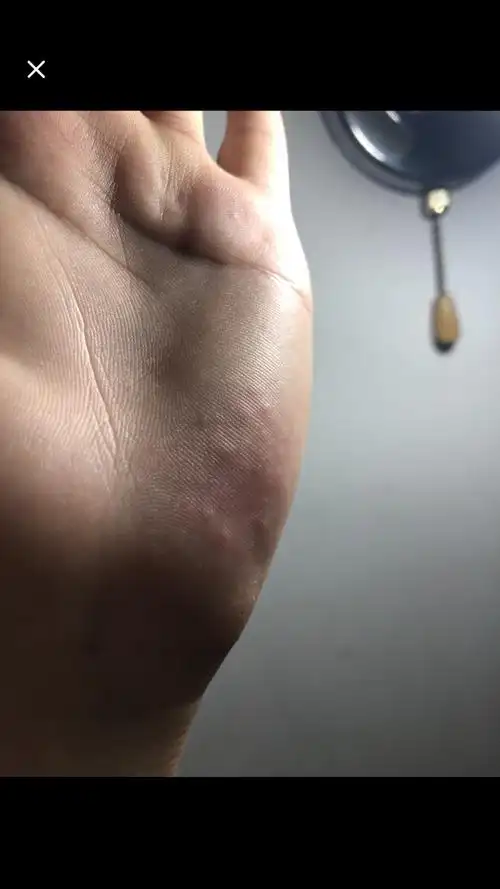 手掌这种小疙瘩,发痒.以前也起过,有印象,自愈.