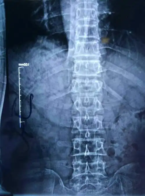 胸12椎体压缩性骨折