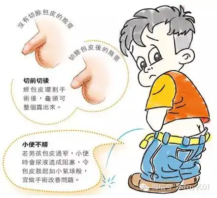 小儿包茎,不可轻视