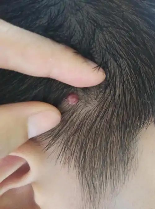 头上长了一个小瘤,两年多,求医生看看