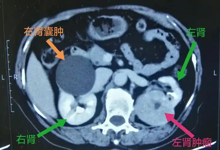 肾囊肿绝大多数是良性疾病,即单纯性肾囊肿.