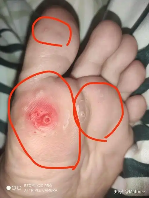 分享跖疣治疗小方法