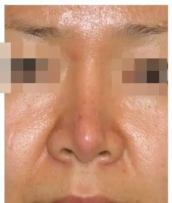 其二:假体易晃动,偏斜