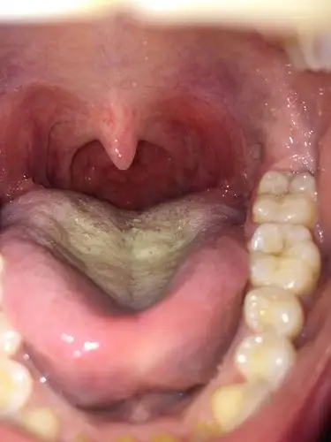 发烧两天 现在不发烧了 嗓子充血 疼 有点痒 咳嗽