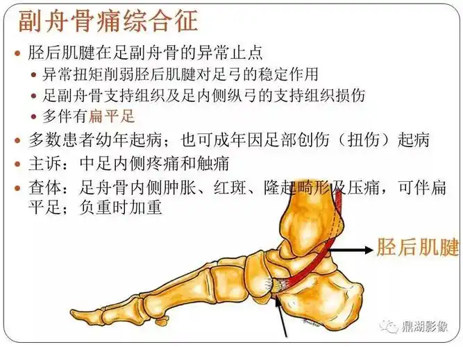 足舟骨结节骨折和副舟骨的鉴别