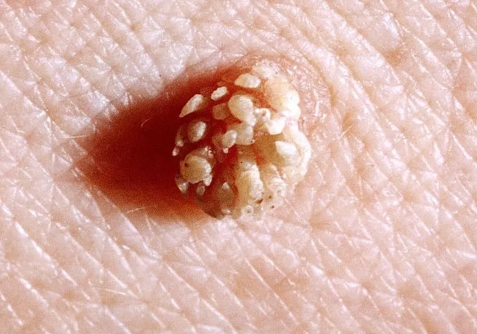 皮肤上的结节该怎么办?_皮肤病_疾病介绍_相关疾病 - 好大夫在线