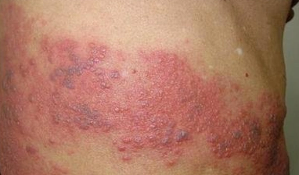 什么叫皮肤飞蛇卵