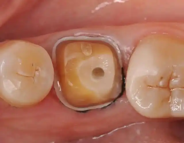 下6治疗后桩冠修复包宇