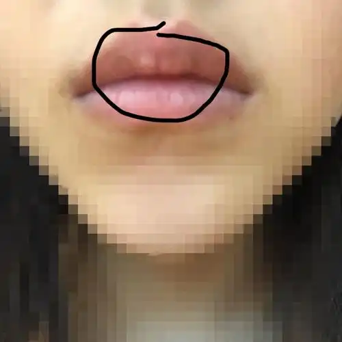 想知道嘴唇上这个白色的为什么会这样?已经一个多月了.