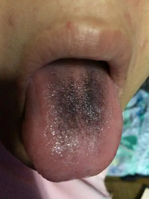 舌苔黑色,刷不掉