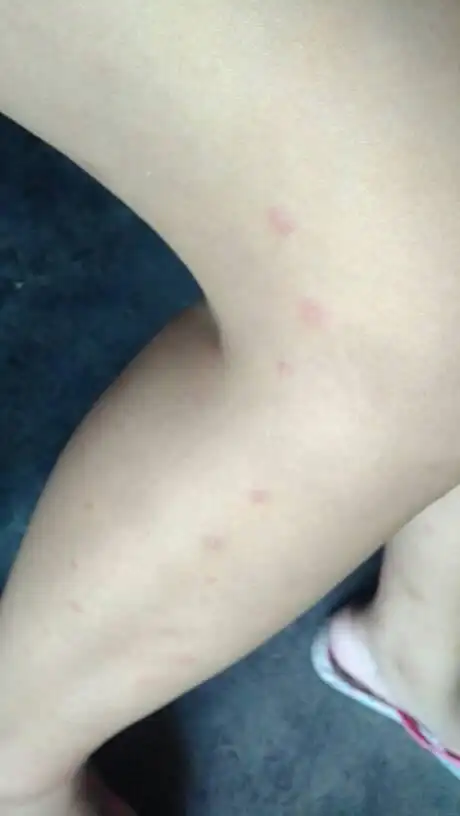 谁知道这起的是什么 水土不服 还是过敏