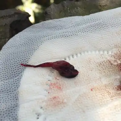 附图,胆小勿入……生化了,四天后排出体外的,这是什麼东西,有和我一样