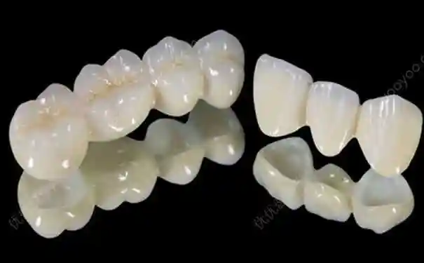 烤瓷牙和全瓷牙区别有哪些?全瓷牙和烤瓷牙哪个好?(1)