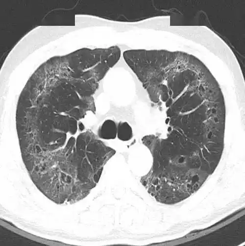 这个间质性肺炎还挺少见的