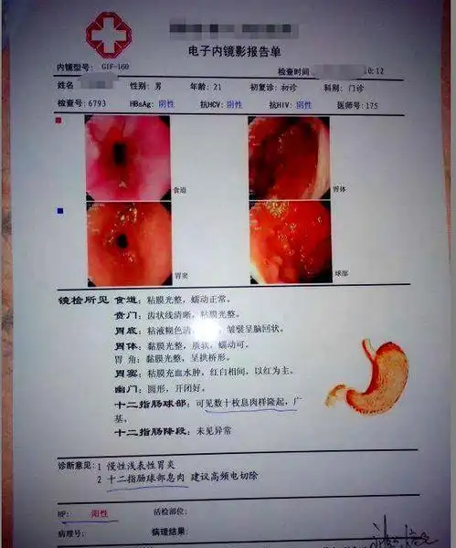 胃溃疡饮食治疗有四大误区