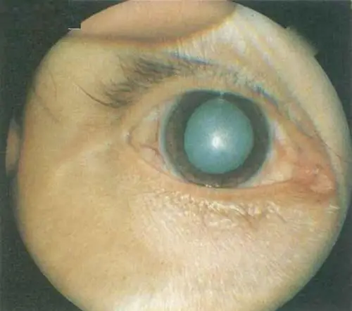 青光眼与白内障那个更严重图片