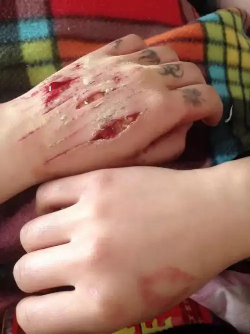 女,一年前因感情纠纷过度自责 给自己造成严重自残 并轻生未成功 如今