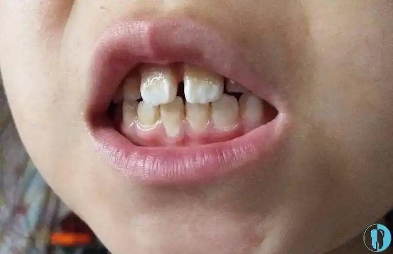 矫正前,虽然门牙外凸,缝隙大,但是突出还没矫正后厉害▼矫正后放飞