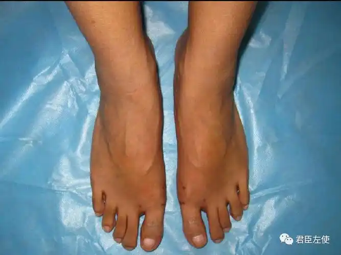 微创治疗拇外翻,为何不用内固定