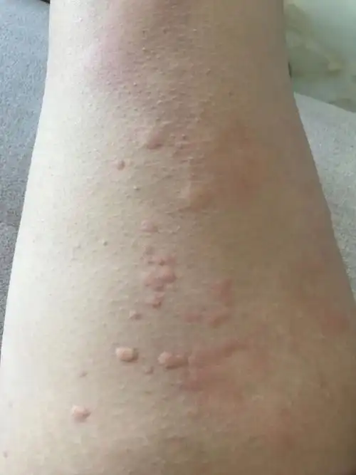 身上起了好多成片的包