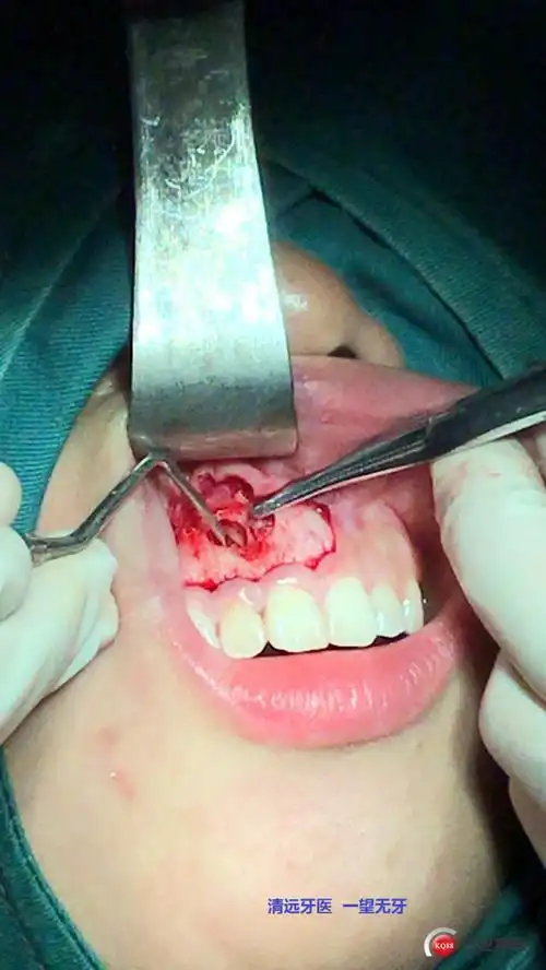 一例超声骨刀摘除上前牙根尖囊肿