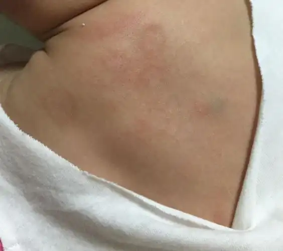 问:女儿二个月了,最近背上发现一圈圈的,表面亮亮