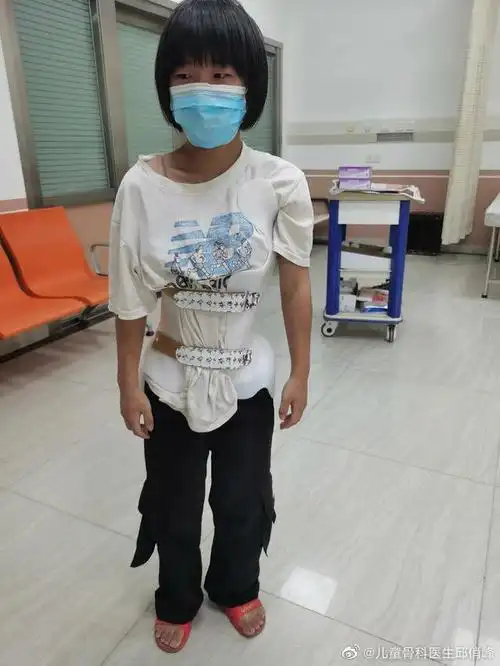 17岁女孩,脊柱侧弯,幸好角度不大,希望她能好好锻炼,穿支具