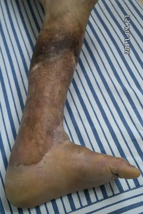 一个静脉曲张并发下肢溃烂病人的慢长就医路 - 好大夫在线