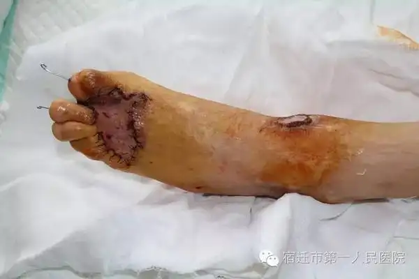 市第一人民医院成功为先天性表皮松解症患者植皮