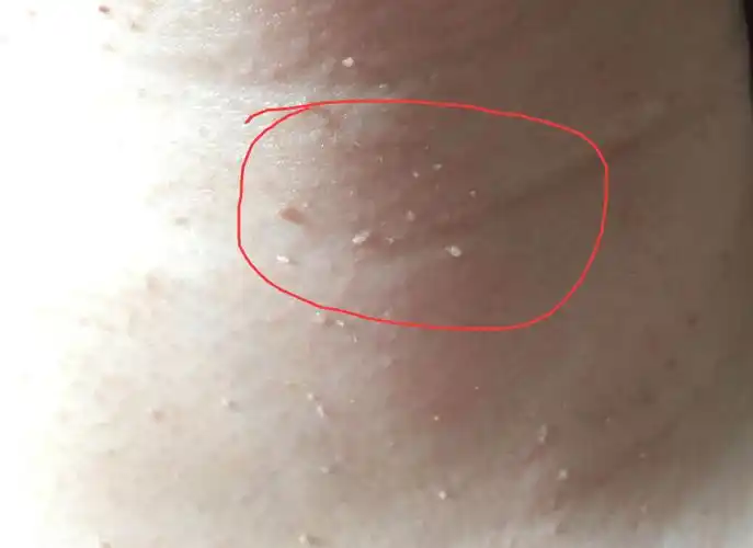 脖子丝状疣照片